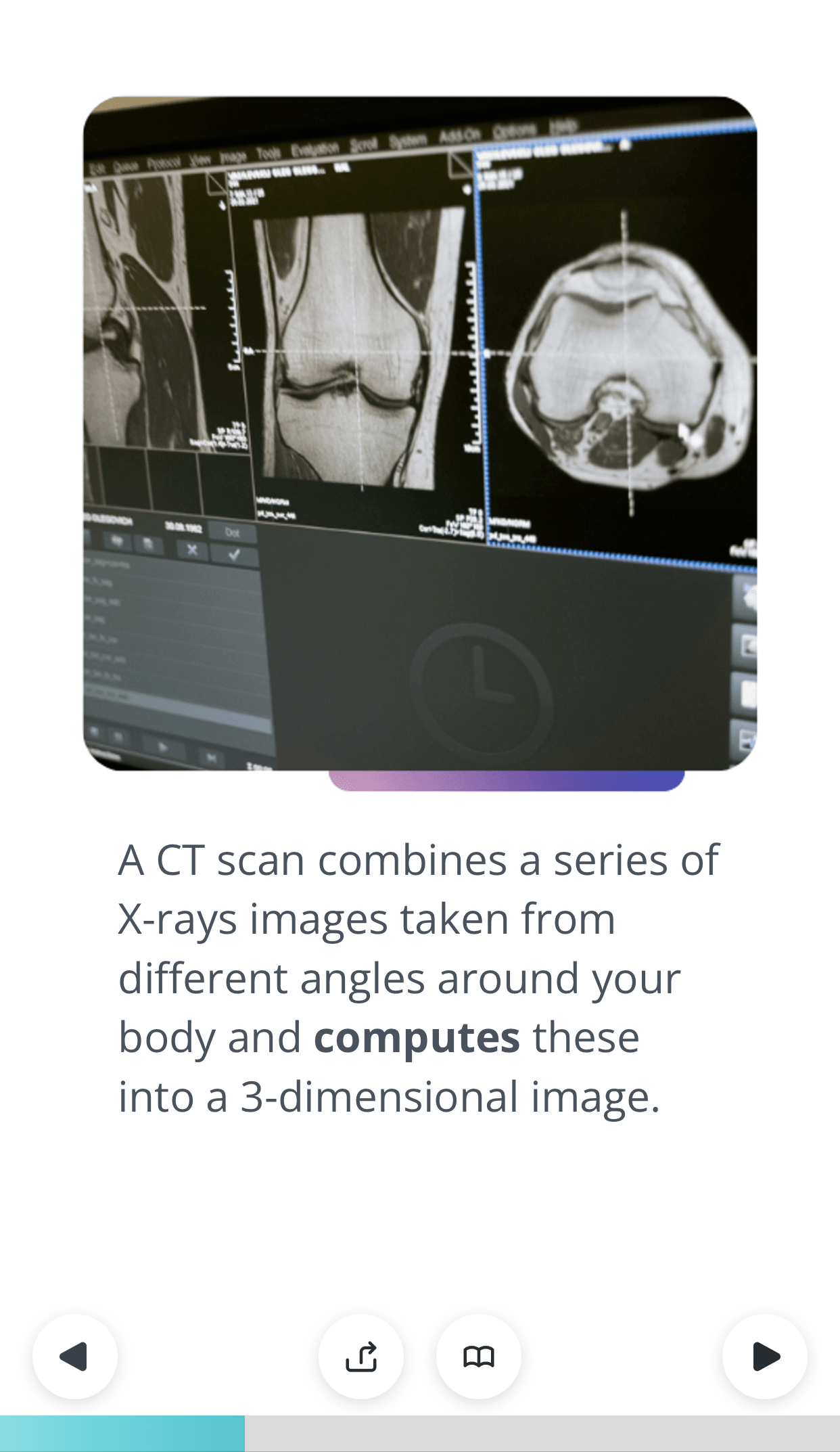A CT scan combines a series of X-rays images taken from different angles around your body and computes these into a dimensional image.
